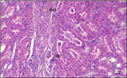 Photomicrogragh of kidney section of diabetic rat showing a trophy of Bowman,s capsules and damage of glomeruli (arrow) and damage of distal and proximal tubules with congested blood vessels (star) . (H&E) (100Px).