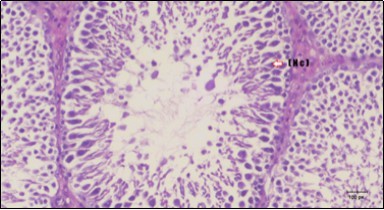 Photomicrogragh of testis section of treated rat with Fenugreek showing noticeable improvement with increased number of spermatogenic cells included moderate amount of spermatozoa (star) and organized Sertoli cells (arrow). Note liquid infiltration (dashed arrow) in wide interstitial tissue (H&E) (40x).