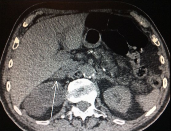 CT scan showing isolated right adrenal NSLC metastasis (Arrow)