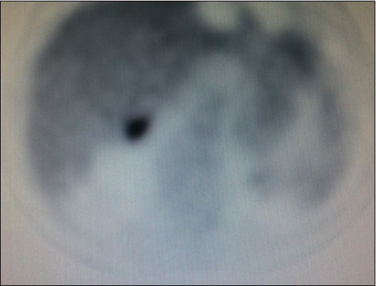 PET-CT with high uptake on right adrenal