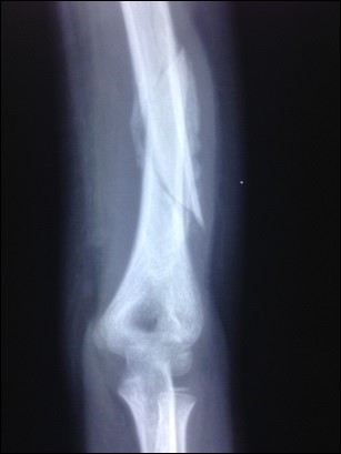 Partially united and angulated humerus shaft fracture prior to LLLT administration in one patient