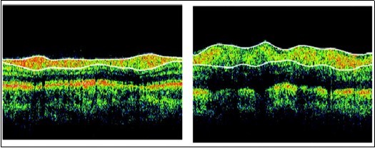 OCT image of Normal (left) and AD (right) (Source: SGM&RF)