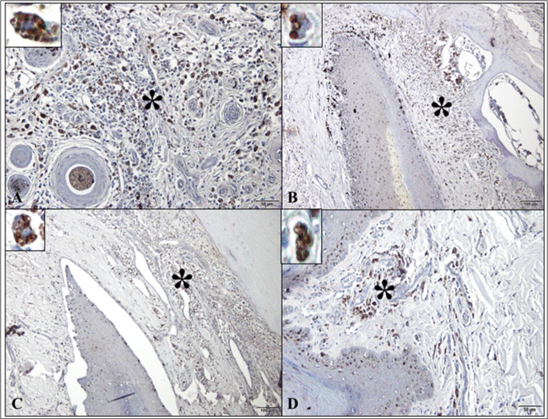 Photomicrographs of Leishmania infantum amastigote immunomarkers in the digit of dogs with visceral leishmaniasis. (A) Note the detection of parasite in the macrophage cytoplasm in the dorsal epidermis/dermis (*; detail; bar=50µm). (B) Parasitized macrophages in the dorsal matrix/dermis (*; detail; bar=100µm). (C) Presence of parasite in the ventral matrix/dermis (*; detail; bar=100µm). (D) Infection with parasitized macrophages in ventral epidermis/dermis (footpad) (*; detail; bar=100µm). Peroxidase-bound polymer complex.