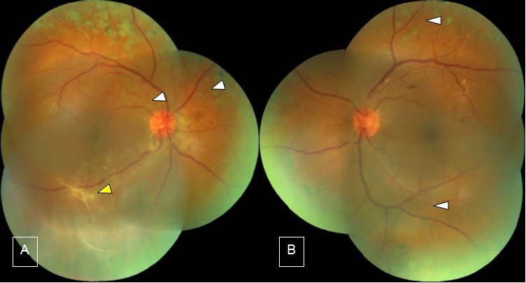 Case 2, Fundus photo OU. A) Right eye, after resolution of vitreous hemorrhage: there are neovascularizations (white arrow), and the yellow arrow points to a fibroproliferative membrane probably this was the source of bleeding, laser scars are seen outside the arcade vessels, foveal reflex is dull. B) Left eye: laser scars outside the vascular arcade, there are suspected neovascularizations seen (white arrows), dot and blot hemorrhages in the nasal and superior retina, exudates in circinate pattern at the superior distal temporal arcade.