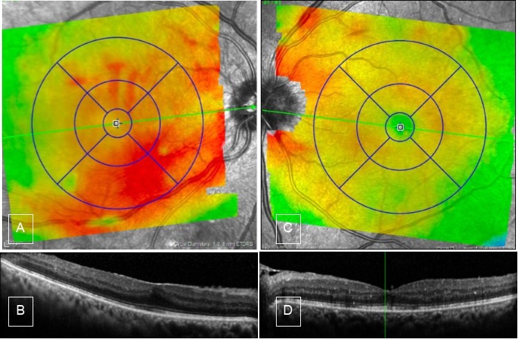 Case 2, OCT, OU. A) Right eye shows thickening of inferior macula. B) high definition scan shows epiretinal membrane which causes straightening of the foveal contour. C & D) Left eye OCT is unremarkable.