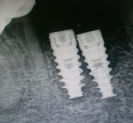 Radiograph – closely positioned implants.