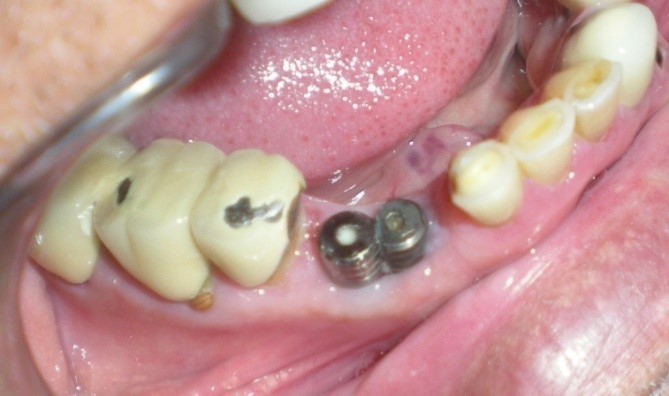 Modified healing abutment in position.