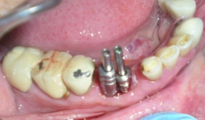 Modified impression copings in proper position.