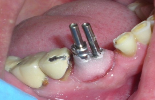 Modified impression copings splinted with unmodified coping with autopolymerizing acrylic resin.