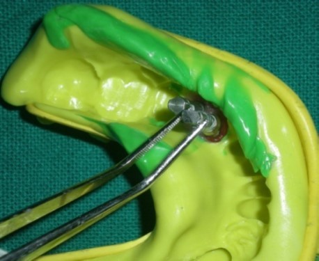 Check the movement of impression coping by holding with tweezer.