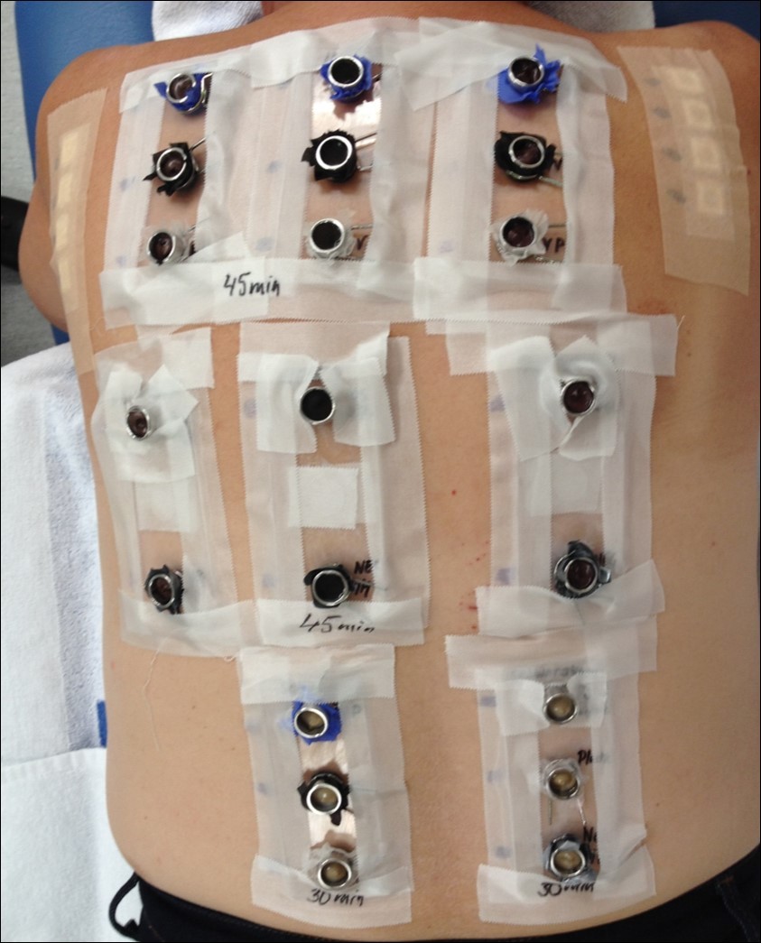 The test device after the application on the back. The chambers were filled with three hair dyes for professional use tested for 45 minutes and on hair dye for home-use tested at 30 minutes.