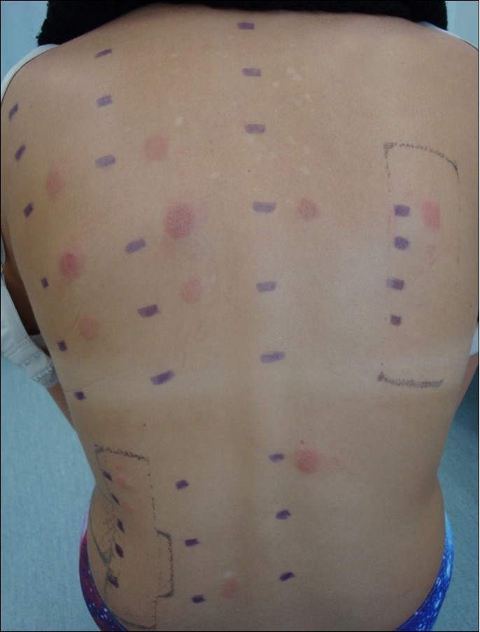 Positive reactions observed at day 4 (D4) in subject n.7.