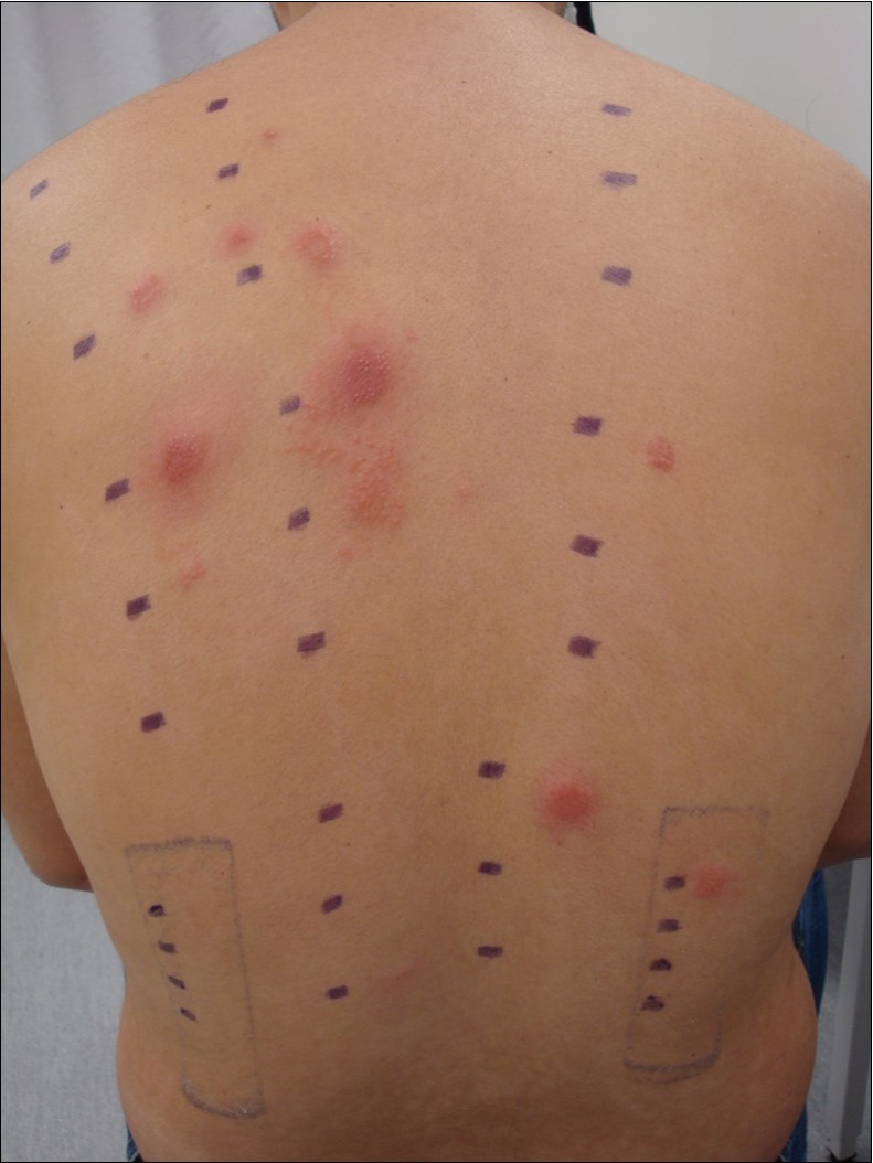 Positive reactions observed at day 4 (D4) in subject n.3.