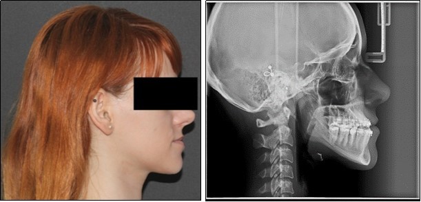 Pre-surgical extraoral photographs, after orthodontic preparation and preoperative lateral cephalometric radiograph