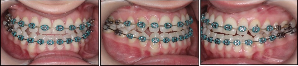Pre-surgical intraoral photographs