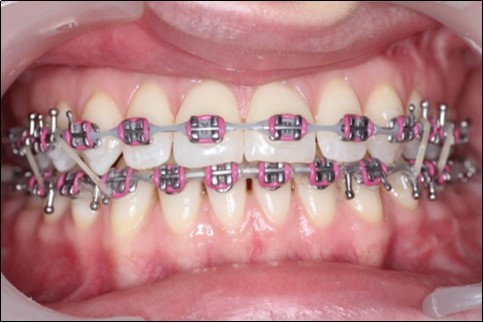 Post-surgical intraoral photographs, with bilateral box elastics