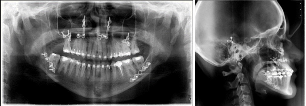 Post-surgical panoramic and lateral cephalometric radiograph.