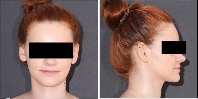 Post-treatment extraoral photographs