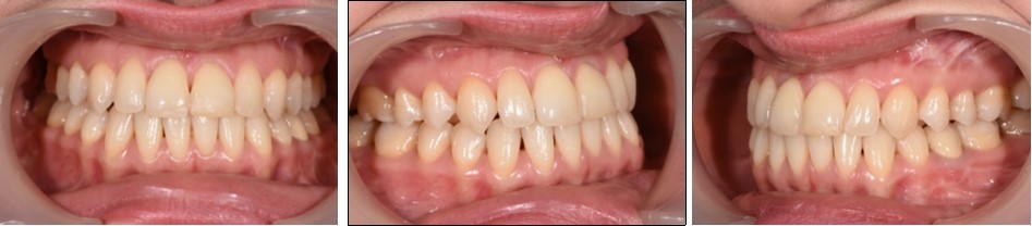 Post-treatment intraoral photographs