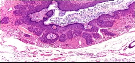 Nevus comedonicus with grouped, dilated follicular ostia, impacted with keratin and a layering of hyperkeratotic stratified squamous epithelium11.