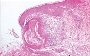 Nevus comedonicus depicting an impacted, distended follicular ostium, keratinous aggregation and a superimposed, acanthotic, hyperkeratotic, stratified squamous epithelium17.