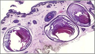 Nevus comedonicus with aggregated follicular ostia, lamellated keratin, hyperkeratotic stratified squamous epithelial lining and an attenuated superimposed epithelium12.