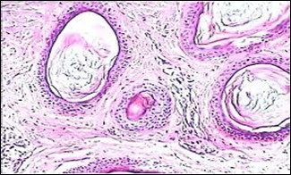 Nevus comedonicus with distended follicular ostia, keratin accumulation, hyperkeratotic epithelial lining and intervening loose fibro-connective tissue13.
