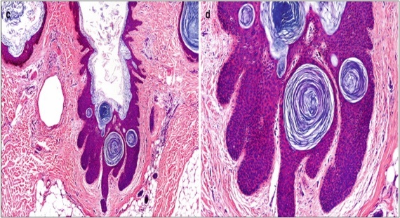 Nevus comedonicus with an aggregation of dilated, plugged follicular ostia, keratinous flakes and an intensely hyperkeratotic stratified squamous epithelial layer16.
