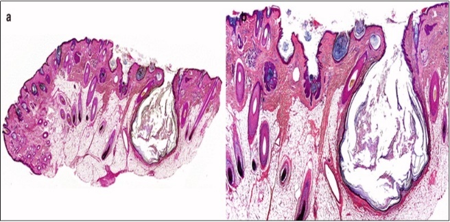 Nevus comedonicus exhibiting aggregates of distended follicular ostia, keratin plugging and a lining of hyperkeratotic stratified squamous epithelium16.