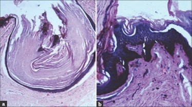 Nevus comedonicus exemplifying a dilated, plugged follicular ostium, keratinous flakes and a layer of stratified squamous epithelium17.