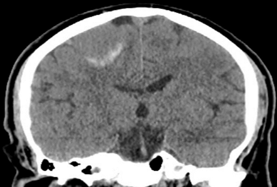 Coronal CT image of a patient with atypical meningioma