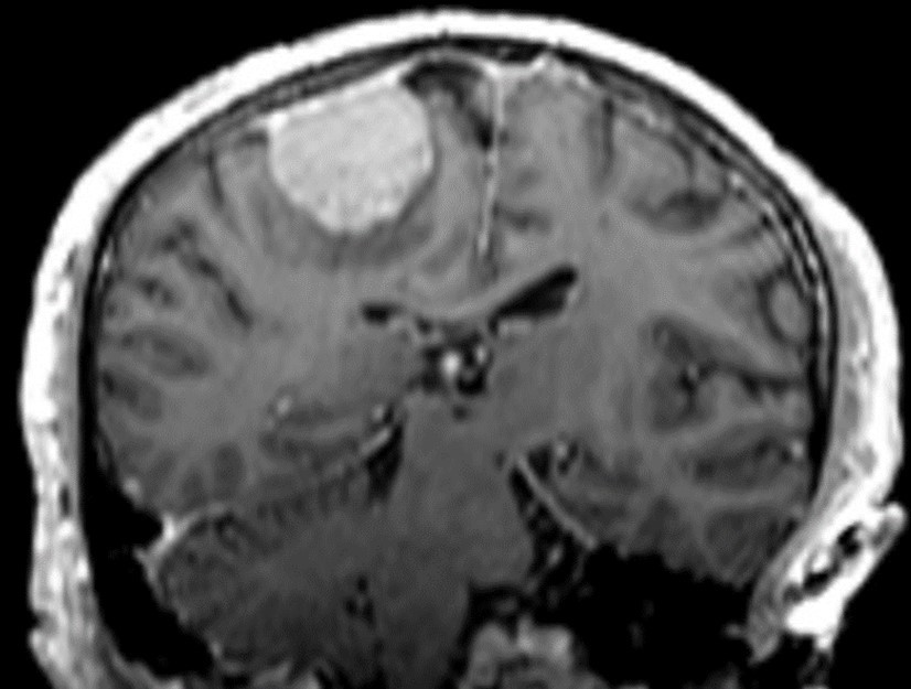 Corresponding coronal MR image of the same patient with atypical meningioma