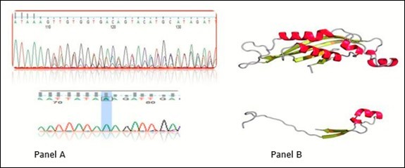 Chromatogram of novel deletion mutation. The upper part of panel A is wild type sequence and the lower part is the truncated mutant PTPS gene. Panel B is the 3D protein structure of PTPS in wild type and mutant one in upper and lower respectively.