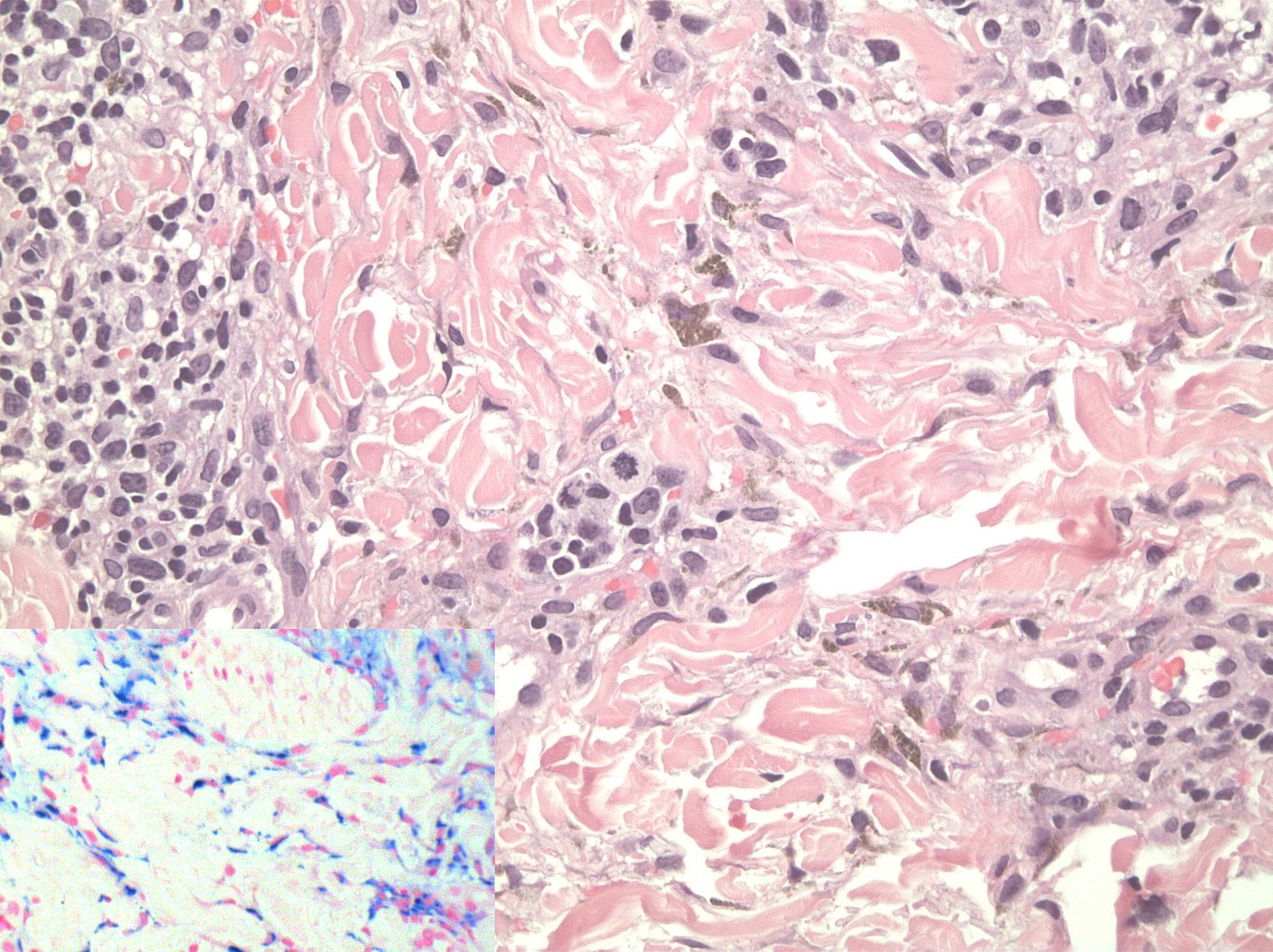 Histology revealed dermal lymphocytic infiltrates with scattered eosinophils, extravasated erythrocytes, and hemosiderin deposition (original magnification, 20). Inset: Perl’s stain highlights hemosidrin depostion (original magnification, 40).