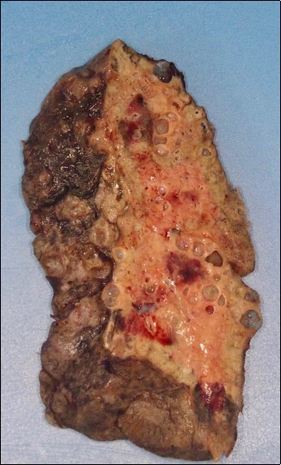 Damaged lung removed following transplantation. Northwestern Medicine
