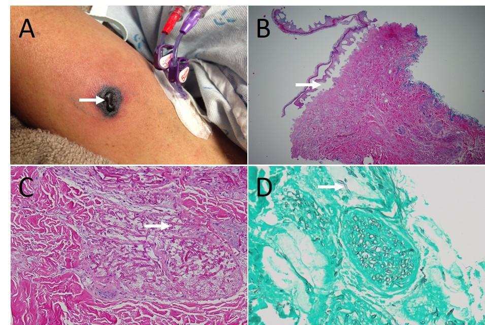 a).Indurated gray and black plaque with a central vesicle (arrow) and surrounding erythema on the left upper arm. B).Biopsy specimen showing numerous angioinvasive fungal organisms in dermis, purpura, and a subepidermal cell-poor bulla (arrow) (hematoxylin-eosin, low power). C).Biopsy specimen showing wide, aseptate hyphae (arrow) branching at right angles (hemotoxylin-eosin, high power). D).Fungal stain showing wide, aseptate hyphae (arrow) branching at right angles (Gomori methenamine silver)
