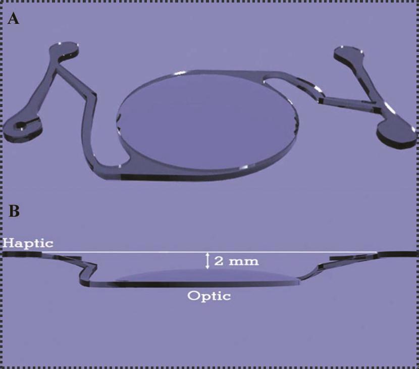 A- Tangential view of the intraocular lens. Note that the trailing haptic has a notch for insertion of a 10/0 nylon suture at the broad end of the haptic. B- Lateral view of the lens. Note that the level of haptics are 2 mm above the level of the optic, the connection between the optic and the haptics pass in a spiral approach to avoid iris chuffing.