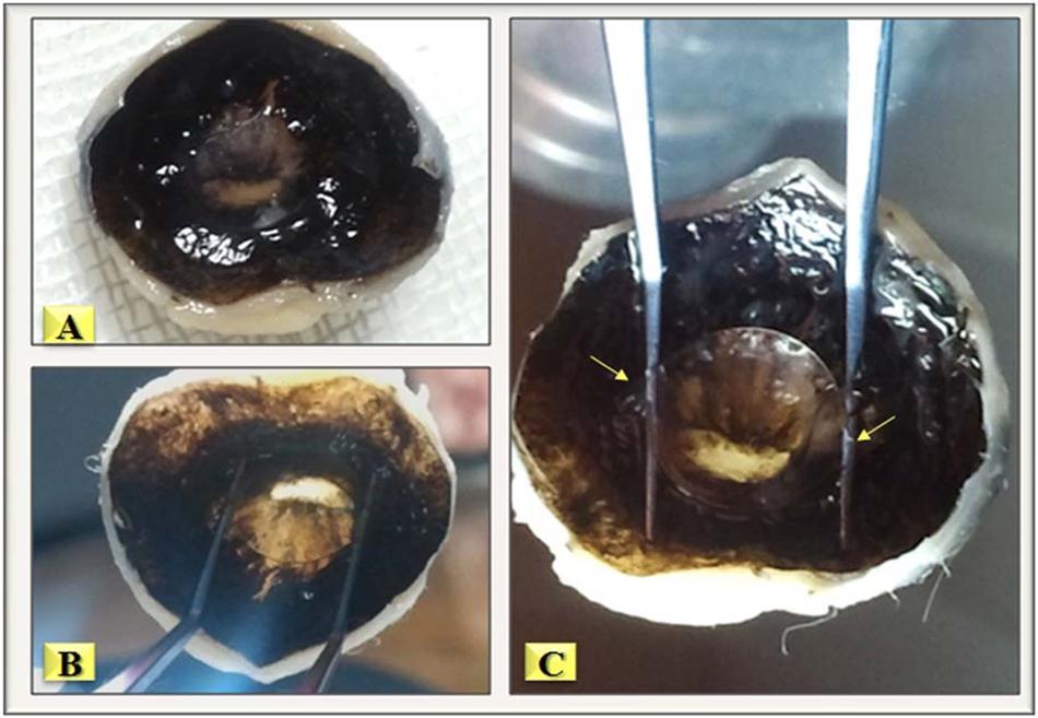 A- Cross-section of the back of the anterior segment of the right eye of a rabbit two months after the operation. Elevation of the IOL from the back surface of the iris is easy with McPherson forceps, the arrows show the junction between the optic and the haptics.