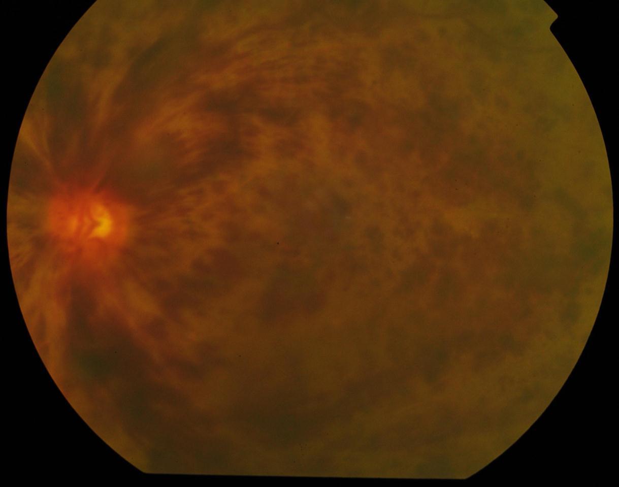 The fundal photograph above shows central retinal vein occlusion (CRVO) of the left eye, associated with macula edema.
