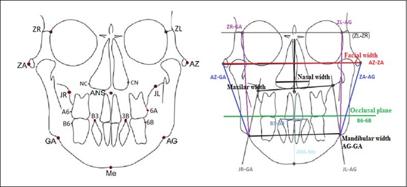Reference points and planes in the Ricketts analysis used to measure cephalometric parameters in facial asymmetry patients