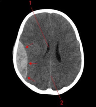 Image of a brain CT scan without contrast, in a parenchymal window, axial view showing a right parietal extra dural hematoma associated with diffuse cerebral oedema, and subfalcorial brain schift