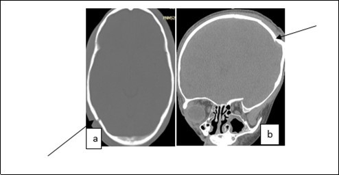 Image of a brain CT scan without contrast agent injection in a bone window, axial section showing a right parieto-occipital fracture (a), coronal section showing a left parietal skull depressed fracture (b)
