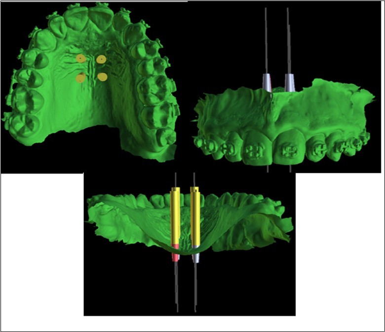 Positioning of the 4 mini-implants, visualized on the basis of the intraoral scan