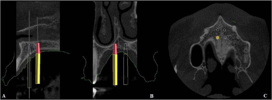 Positioning of the mini-implants on CBCT, A. Sagittal section, B. Coronal section, C. Axial section