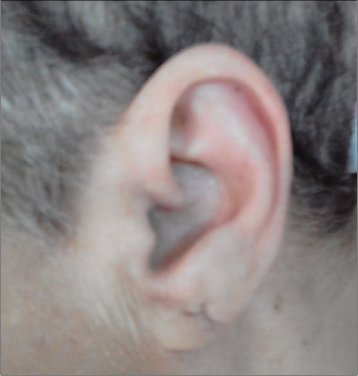 normal left ear