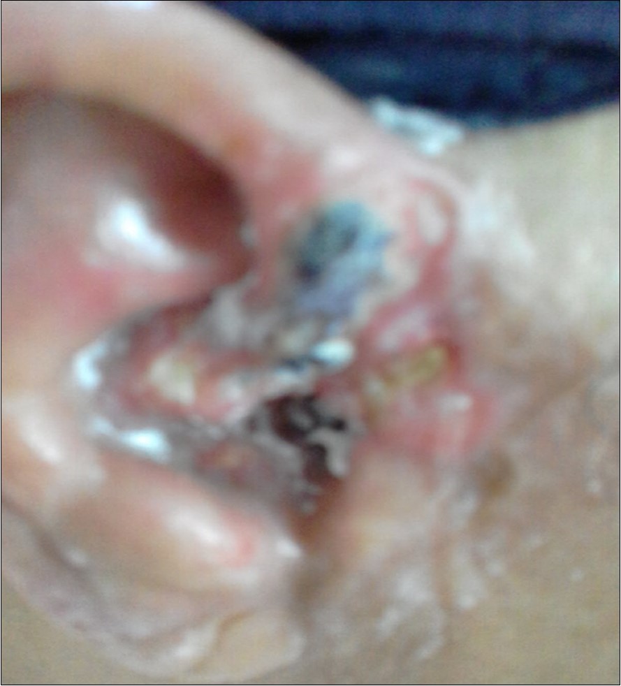 Right ear; Basal Cell Carcinoma (BCC) seen in the skin of ear and adjacent areas, sloughing of cancer cells seen after Bee Venom subcutaneous injection.