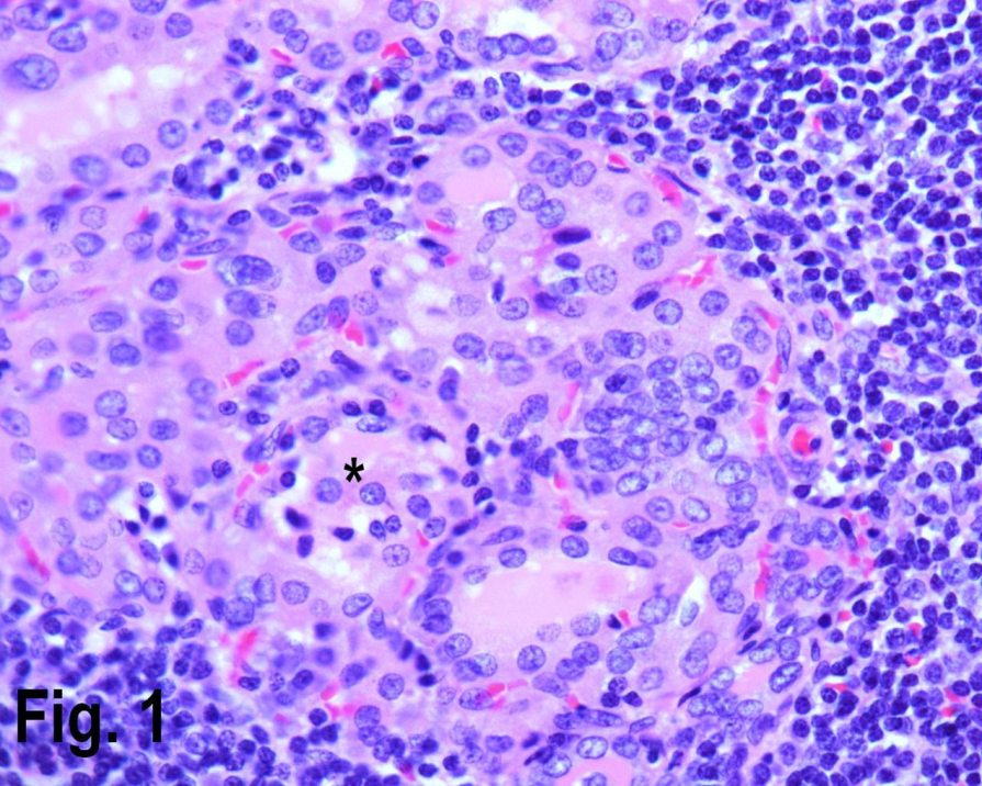 High power view showing Hashimoto’s thyroiditis with lymphocytic infiltrate in the periphery and Hurthle cells {asterisk} in the center. (Hematoxylin & eosin, original magnification ×400).