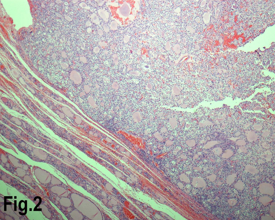 Low power view showing a follicular adenoma. (Hematoxylin & eosin, original magnification ×200).