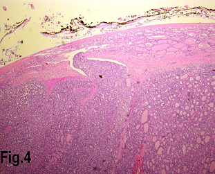 Low power view showing a follicular carcinoma with capsular invasion. (Hematoxylin & eosin, original magnification ×200).