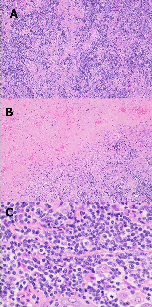 Representative photomicrographs of the excisional biopsy of a right neck lymph node. Low power view showing the lymph node architecture was effaced by a diffuse lymphohistiocytic infiltrate (A) with extensive geographic necrosis (B). At high power, the lymphocytes are small to intermediate in size; they have round or oval to slightly irregular nuclei, coarse chromatin, and sometimes small nucleoli (C). (H&E stain; original magnification, x 100 A and B, x 400 C).
